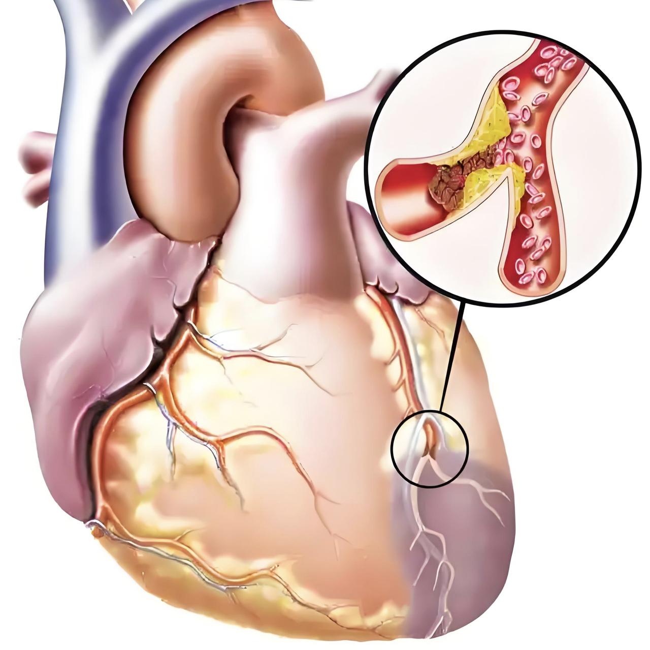 Coronary stent implantation